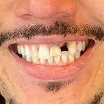 Caso clínico autorizado, antes do tratamento estético dental