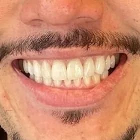 Caso clínico autorizado, depois do tratamento estético dental