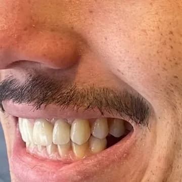 Caso clínico autorizado, depois do tratamento com prótese